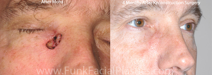 Skin Cancer Reconstruction Houston