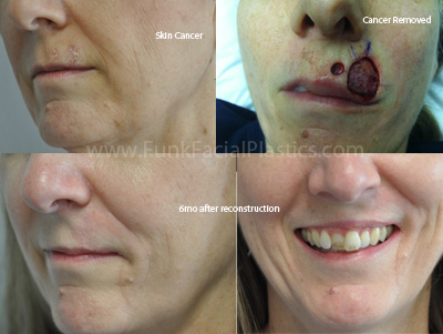 Lip reconstruction after Mohs in Houston