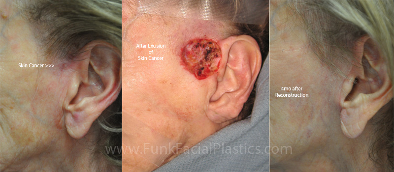 Reconstruction after skin cancer