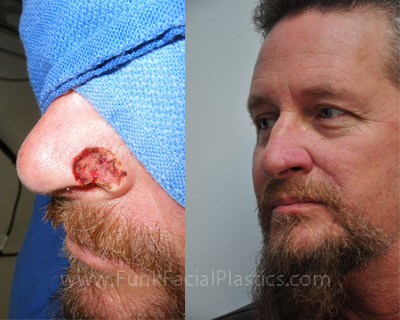 Nose surgery for skin cancer reconstruction Houston