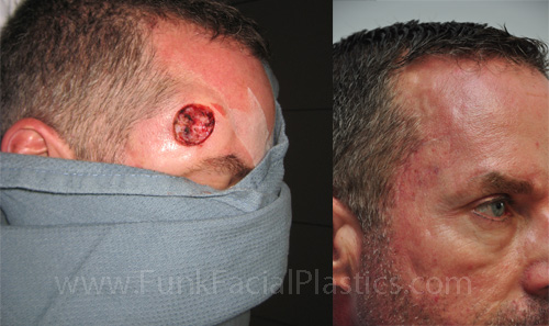 Skin cancer reconstruction Houston