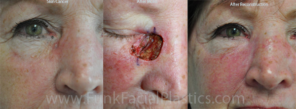 Skin cancer reconstruction Houston, TX