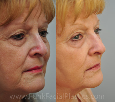 Nose reconstruction after skin cancer surgery in Houston