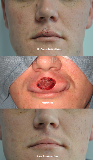 Lip skin cancer reconstruction